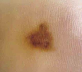 A new mark on a woman's foot resembled melanoma.