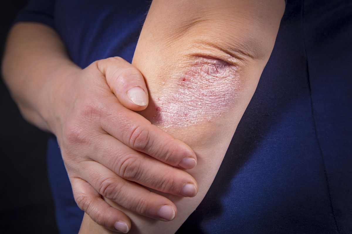 What Is Psoriasis? - Livescience.com thumbnail