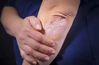 Plaque psoriasis on the elbow.