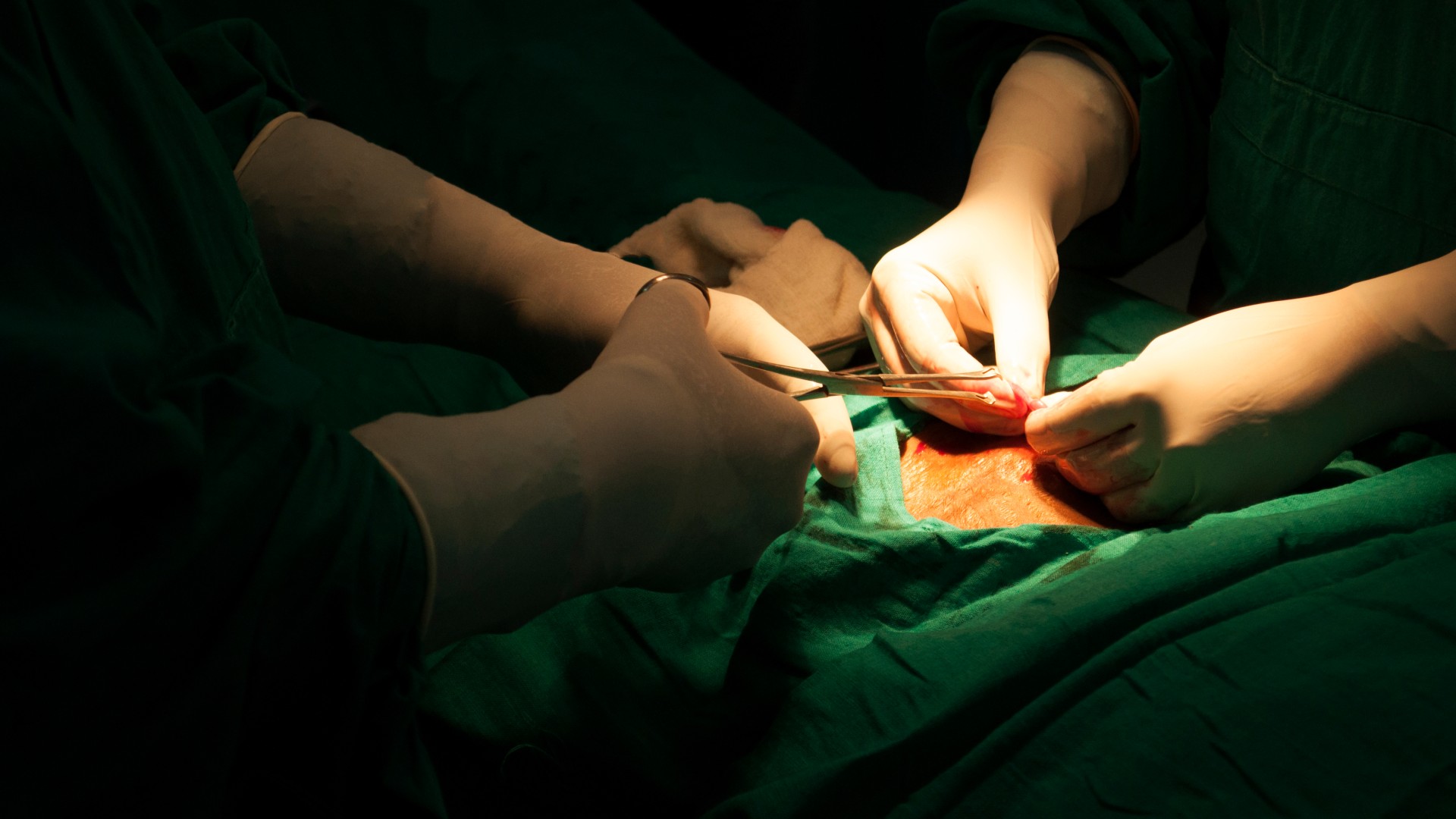 Close-up image of doctors performing tubal ligation on a patient. The image is dark with only the hands of the surgeons in their white gloves on display, as well as the outline of the patient's torso in a green surgical gown. One of the surgeons on the left is using scissors to perform an incision. An opening in the surgical gown shows the patients opened body. Some blood can be seen.