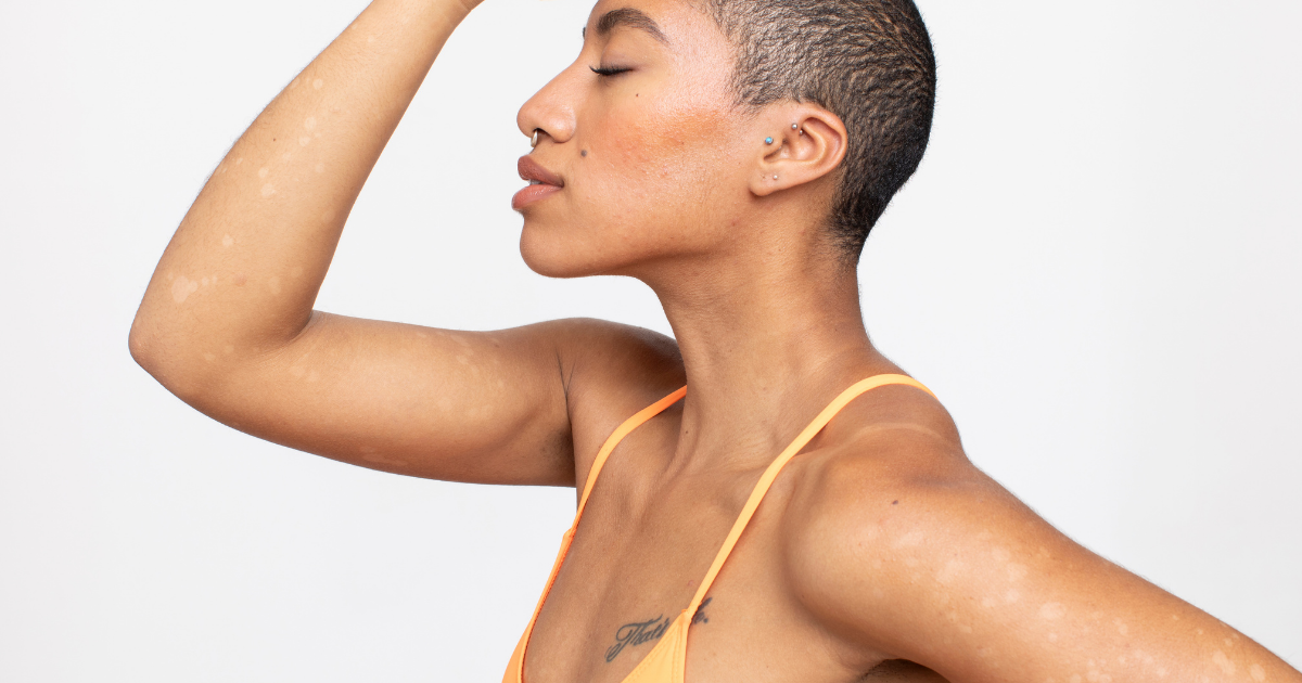 Hypopigmentation