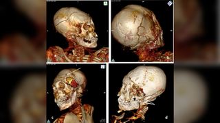 A 3D CT scan of the skull of one of the South American mummies in the new study.