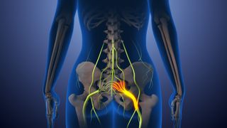 Medical illustration of the back of a person. All that is visible is the outline of the person in blue and their skeleton. Nerves in the lower back are shown in bright green and the sciatic nerve is highlighted in bright yellow.