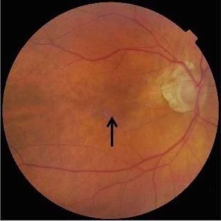 This photograph reveals the swelling (black arrow) near the macular hole in the woman's right eye caused by a lightning strike.