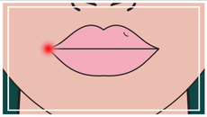 An illustrated graphic of a face with a cold sore