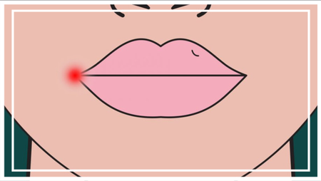 An illustrated graphic of a face with a cold sore