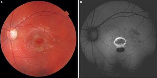 A 9-year-old boy in Greece burned a hole in his retina (which appears in the center of the images above) after staring into a laser pointer. 