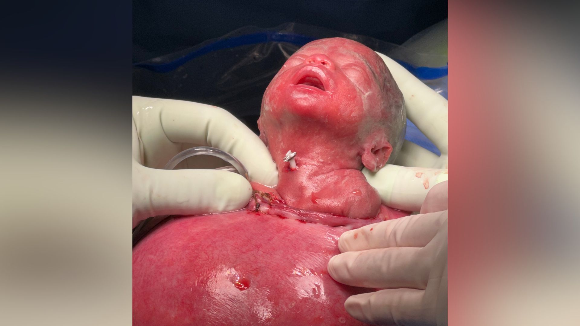 Photo of a fetus's head and shoulders being exposed out of a mother's abdomen. Two gloved hands are seen supporting the partially exposed fetus