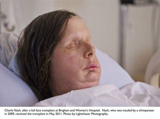 face-transplant-110811-02