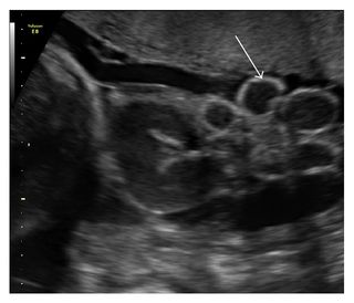 Ultrasound image showing loops of bowel floating freely in amniotic fluid in a fetus at 31 weeks of gestation.