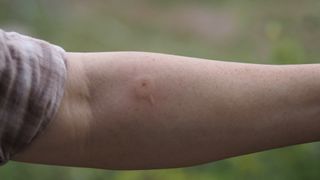 insect bite on a man's arm