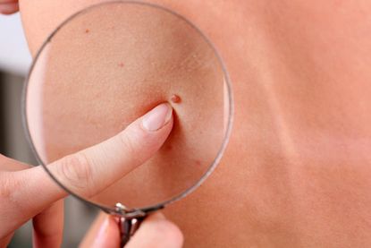 Researchers: There may be a link between moles and breast cancer