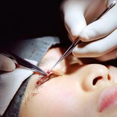 photograph of woman undergoing eyelid surgery