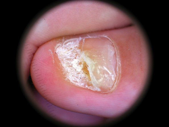 A close up of a thumbnail under a circular microscope lens, where the nail has streaks of white.