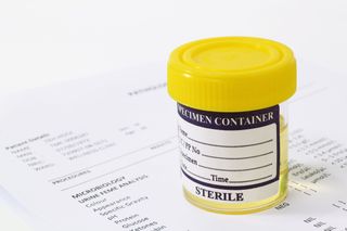 A urine sample with test results.