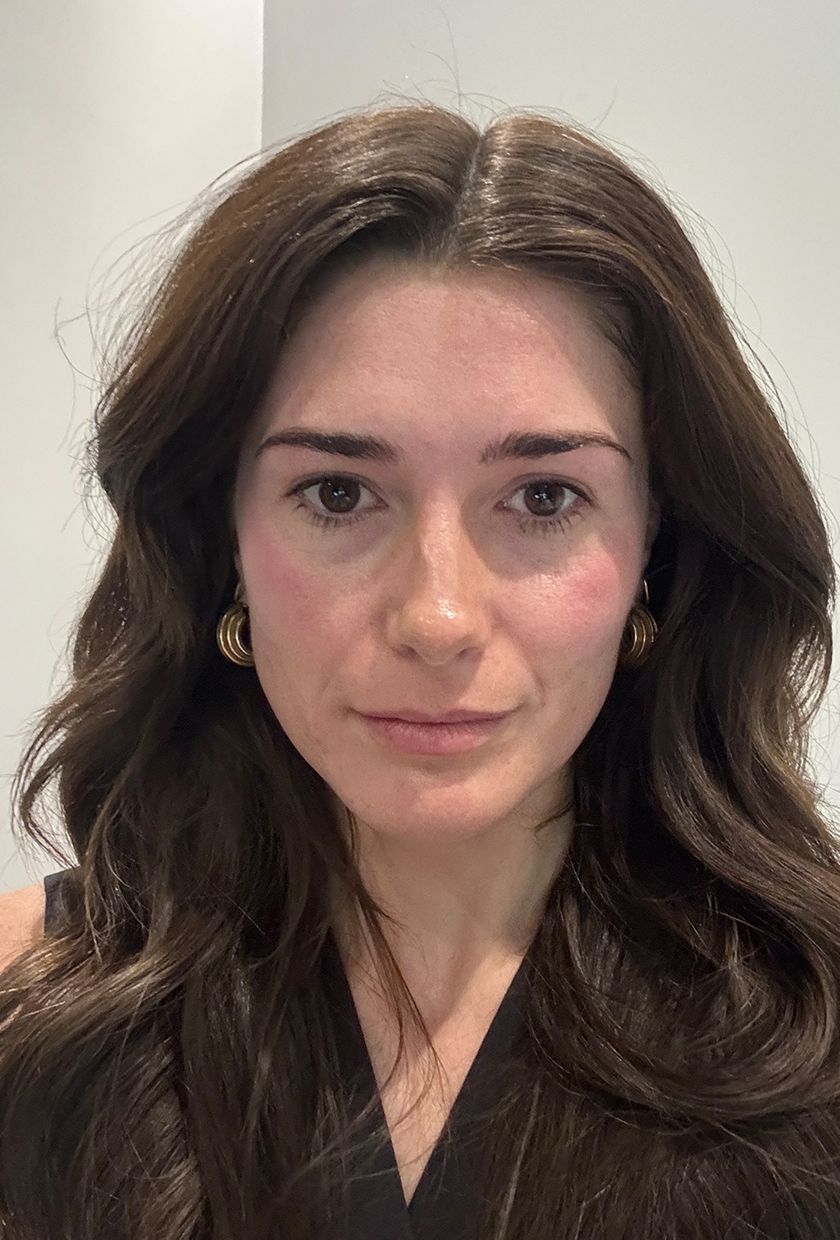 Immediately after the Sofwave treatment