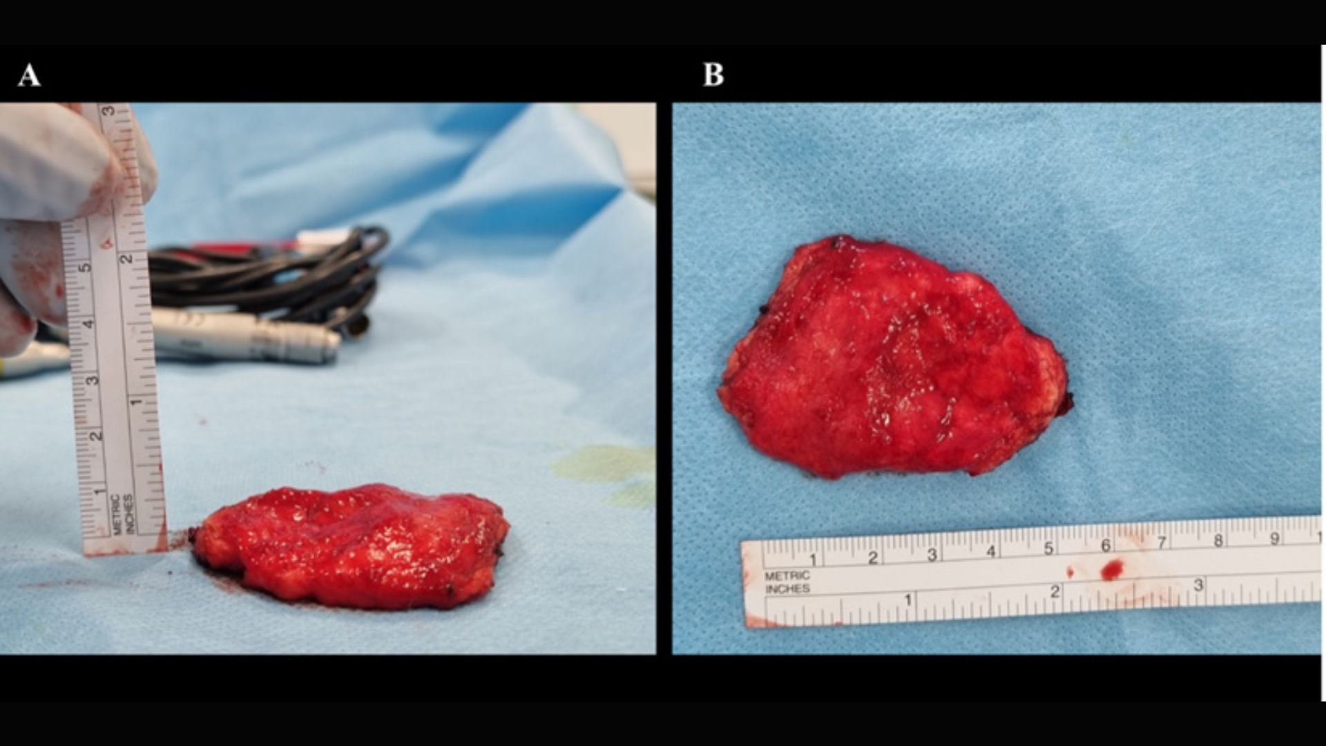 dua gambar tumor merah terang di atas handuk biru. Tangan yang bersarung tangan memegang penggaris di sebelah tumor untuk menunjukkan panjang dan ketebalannya