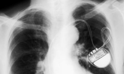 A pacemaker in an x-rayed chest: The life-saving device may be vulnerable to hackers.