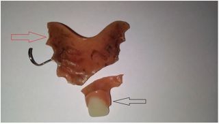 This picture shows the piece of the denture (red arrow) that was removed from the man’s esophagus, along with the remaining part of the denture that was not swallowed (black arrow).