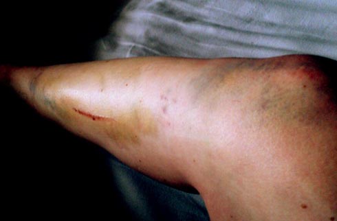 Lauren Shannon's bruised leg