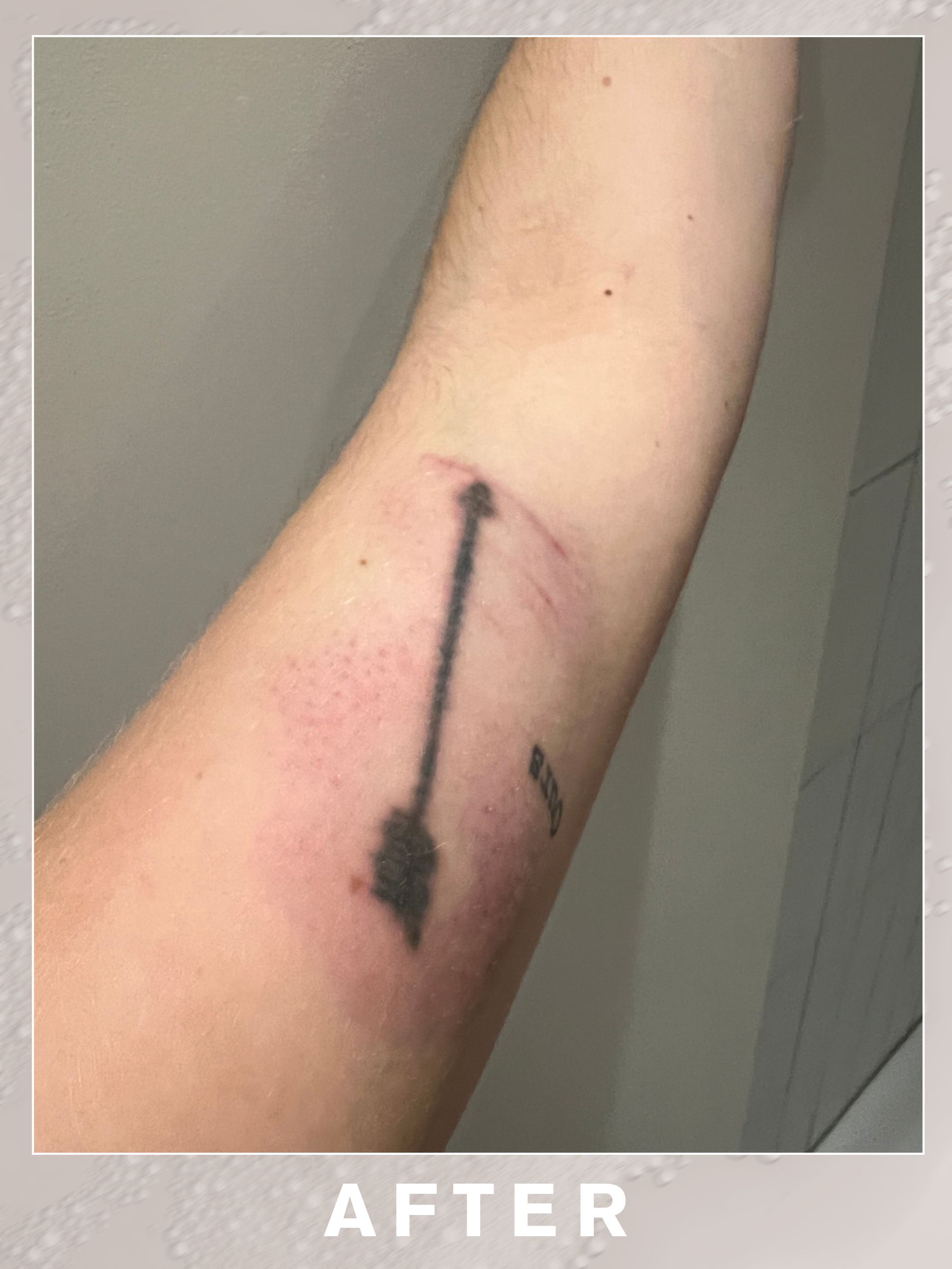 An after picture after an editor has her second tattoo removal session