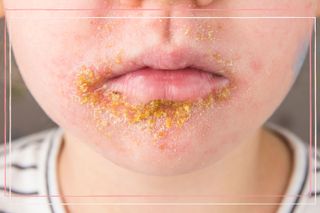 Close up of 5 year old child with Impetigo that is presenting as yellow golden crusty scabs around the mouth.