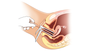 Medical illustration of a speculum being inserted into a vagina