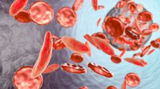 Sickle cell anaemia. Artwork showing normal red blood cells (round), and red blood cells affected by sickle cell anaemia (crescent shaped). This is a disease in which the red blood cells contain an abnormal form of haemoglobin (bloods oxygen-carrying pigment) that causes the blood cells to become sickle-shaped, rather than round. Sickle cells cannot move through small blood vessels as easily as normal cells and so can cause blockages (right). This prevents oxygen from reaching the tissues, causing severe pain and organ damage.