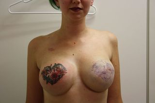 Nikki Black showing completed floral tattoo on right breast, outline on left scarred breast