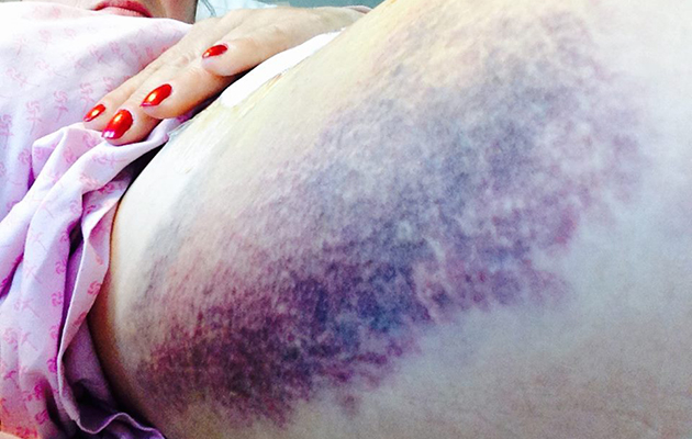 janinebruise