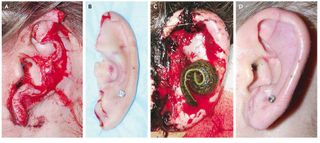 ear before and after reattachment surgery