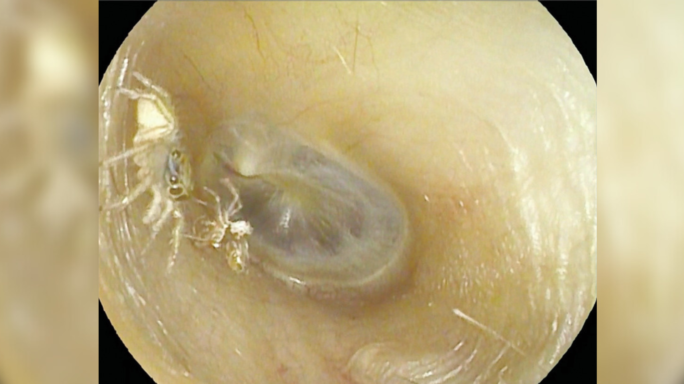 Spinder In Ear Horrifying video reveals molting spider rustling in woman's ear | Live ...