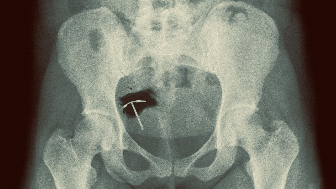 Photo collage of an X-ray of a woman&#039;s pelvis, and an IUD tearing a hole through it