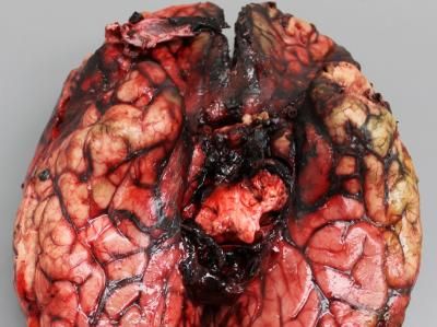 A view of the base of the brain with hemorrhage of the arteries. 