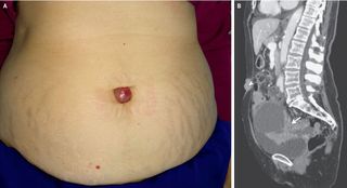 A woman in Spain had a lump protruding out of her belly button that turned out to be cancer. Above, an image of the lump (left) and a CT scan showing massess in the pelvis and near the belly button area (right, arrows).