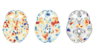 Three grainy brain scans shown against a white background. Blue, yellow, orange and red blotches can be shown on the scans.