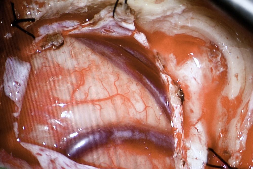 close-up image of an open brain during live-tweeted surgery