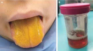 A boy's yellow tongue (left) was a sign of a rare autoimmune disorder. He also developed dark urine (right).