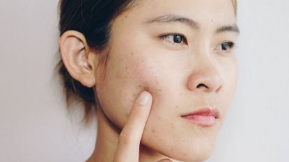 close up of young woman with acne on cheeks