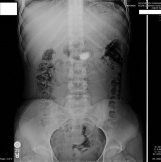 An X-ray showing the Misfit Shine in the girl's stomach.