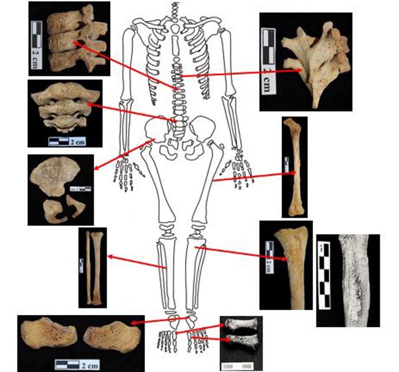 These Skeletons From An Ancient Egypt Cemetery Were Riddled With Cancer ...