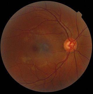 Ophtalmogram of a human eye. 