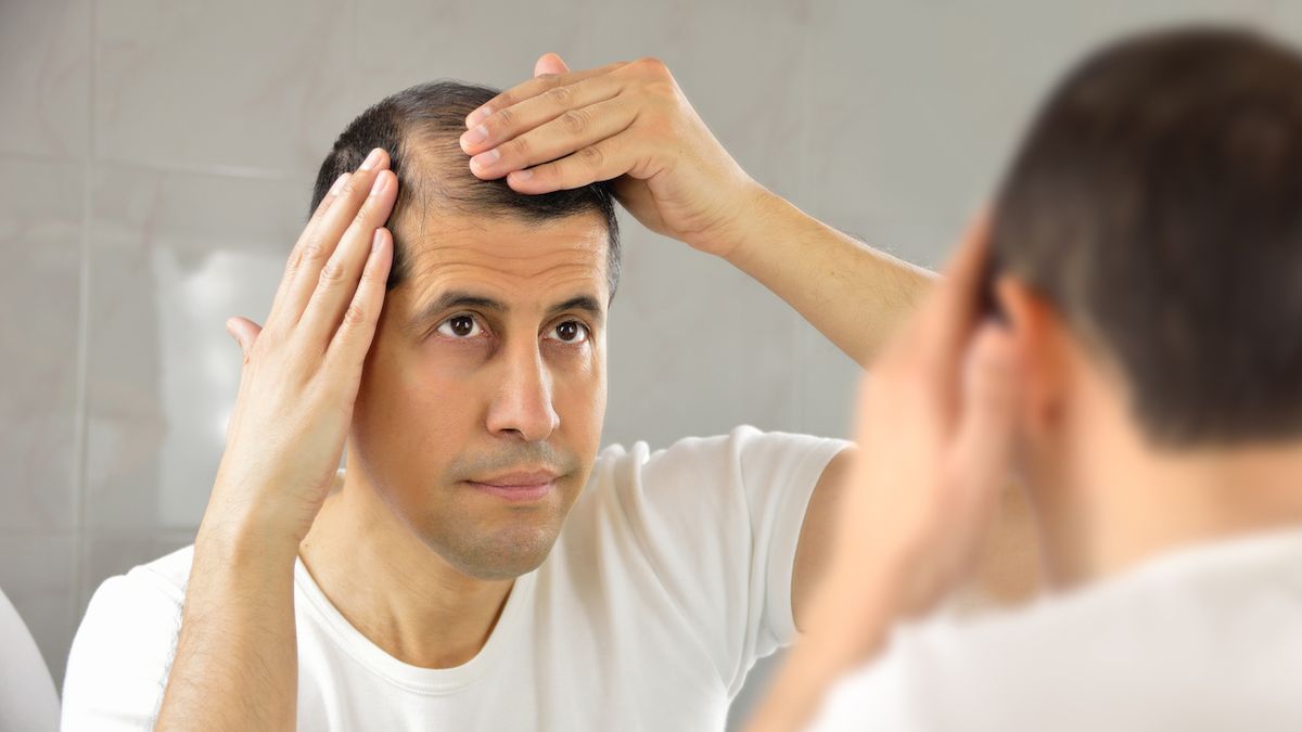 Alopecia Causes Symptoms Treatments For Hair Loss And Balding Live Science