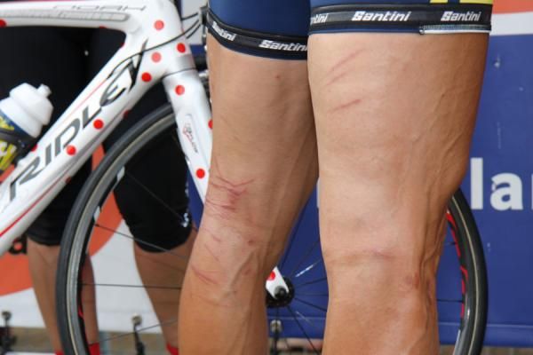 The scars are still apparent on the legs of Johnny Hoogerland