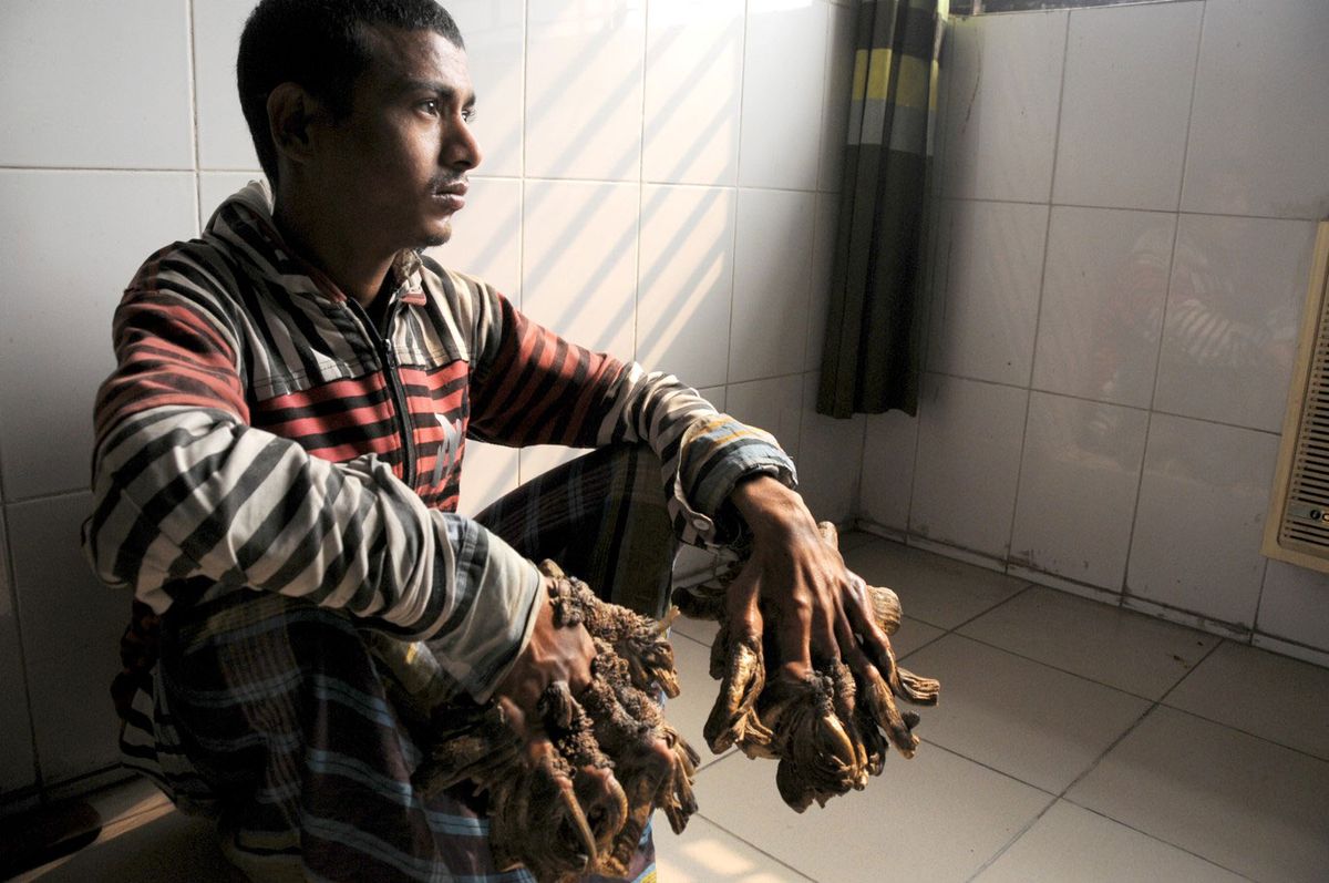 Tree Man Has Surgery What Causes This Rare Condition Live Science