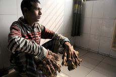 Abul Bajandar, known as the "tree man," had extensive, wood-like warts on his hands.
