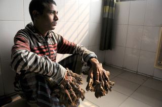 Abul Bajandar, known as the &quot;tree man,&quot; had extensive, wood-like warts on his hands.