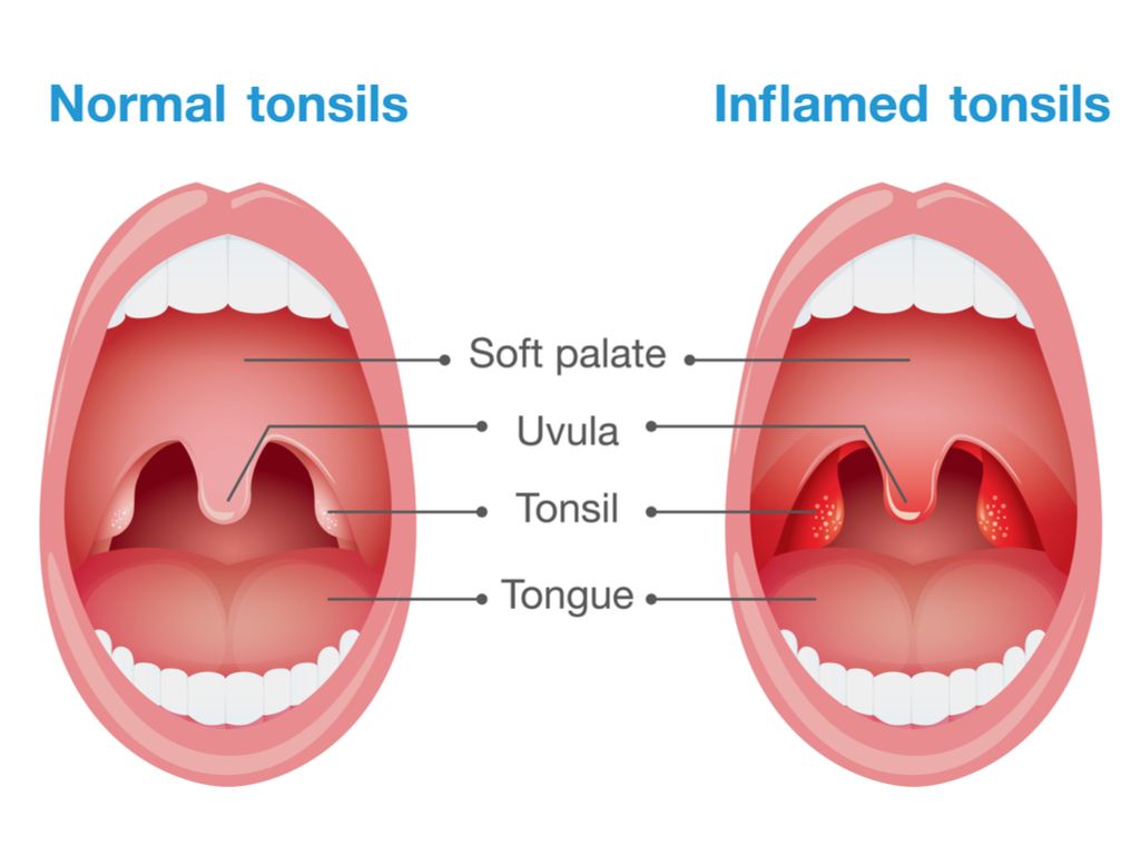 best-dental-clinics-9381070890-what-is-tonsillitis-clinical-features