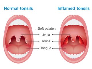 tonsils tonsillitis strep