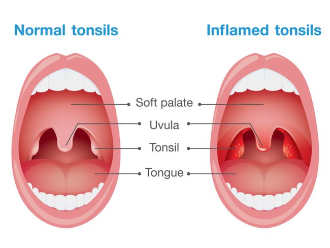 tonsil-problems-andrew-foreman-ent